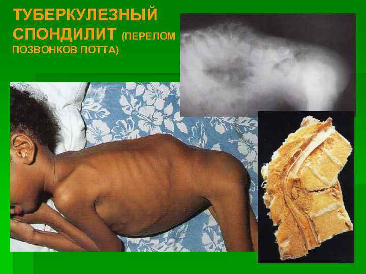 ТУБЕРКУЛЕЗНЫЙ СПОНДИЛИТ (ПЕРЕЛОМ ПОЗВОНКОВ ПОТТА) 