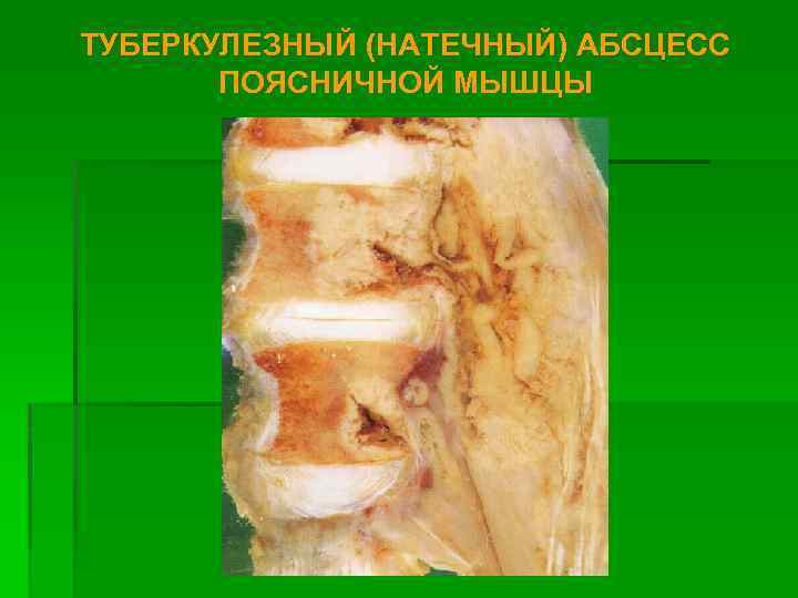 ТУБЕРКУЛЕЗНЫЙ (НАТЕЧНЫЙ) АБСЦЕСС ПОЯСНИЧНОЙ МЫШЦЫ 