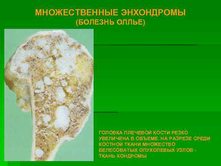 МНОЖЕСТВЕННЫЕ ЭНХОНДРОМЫ (БОЛЕЗНЬ ОЛЛЬЕ) ГОЛОВКА ПЛЕЧЕВОЙ КОСТИ РЕЗКО УВЕЛИЧЕНА В ОБЪЕМЕ. НА РАЗРЕЗЕ СРЕДИ