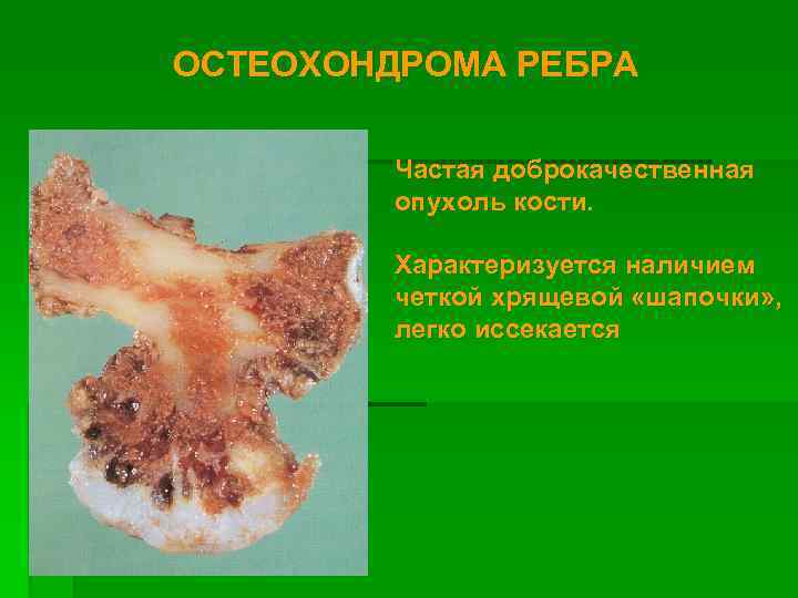 ОСТЕОХОНДРОМА РЕБРА Частая доброкачественная опухоль кости. Характеризуется наличием четкой хрящевой «шапочки» , легко иссекается