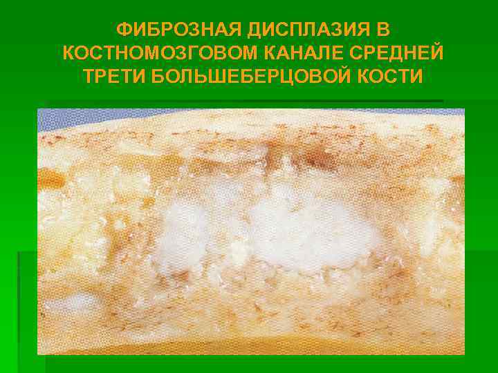 ФИБРОЗНАЯ ДИСПЛАЗИЯ В КОСТНОМОЗГОВОМ КАНАЛЕ СРЕДНЕЙ ТРЕТИ БОЛЬШЕБЕРЦОВОЙ КОСТИ 