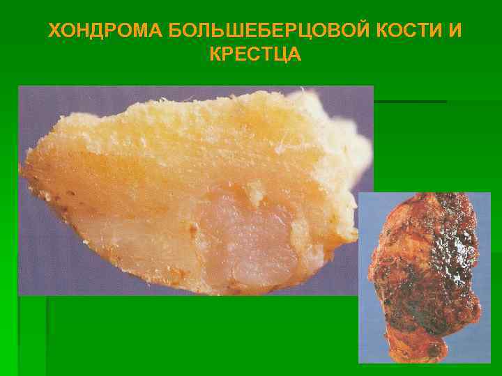 ХОНДРОМА БОЛЬШЕБЕРЦОВОЙ КОСТИ И КРЕСТЦА 