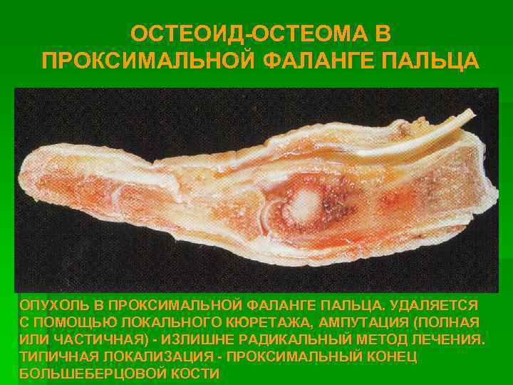 ОСТЕОИД-ОСТЕОМА В ПРОКСИМАЛЬНОЙ ФАЛАНГЕ ПАЛЬЦА ОПУХОЛЬ В ПРОКСИМАЛЬНОЙ ФАЛАНГЕ ПАЛЬЦА. УДАЛЯЕТСЯ С ПОМОЩЬЮ ЛОКАЛЬНОГО