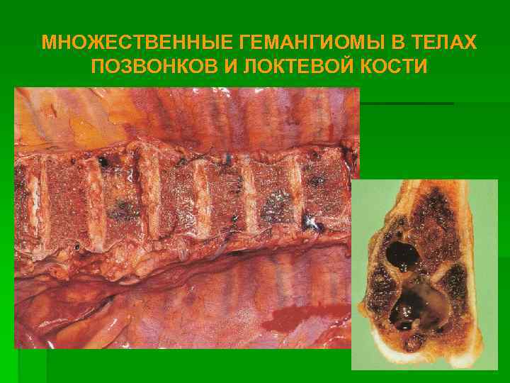 МНОЖЕСТВЕННЫЕ ГЕМАНГИОМЫ В ТЕЛАХ ПОЗВОНКОВ И ЛОКТЕВОЙ КОСТИ 