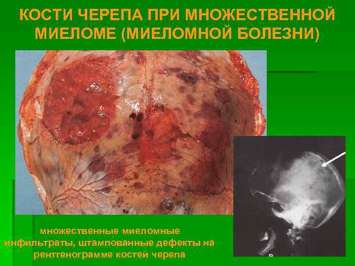 КОСТИ ЧЕРЕПА ПРИ МНОЖЕСТВЕННОЙ МИЕЛОМЕ (МИЕЛОМНОЙ БОЛЕЗНИ) множественные миеломные инфильтраты, штампованные дефекты на рентгенограмме