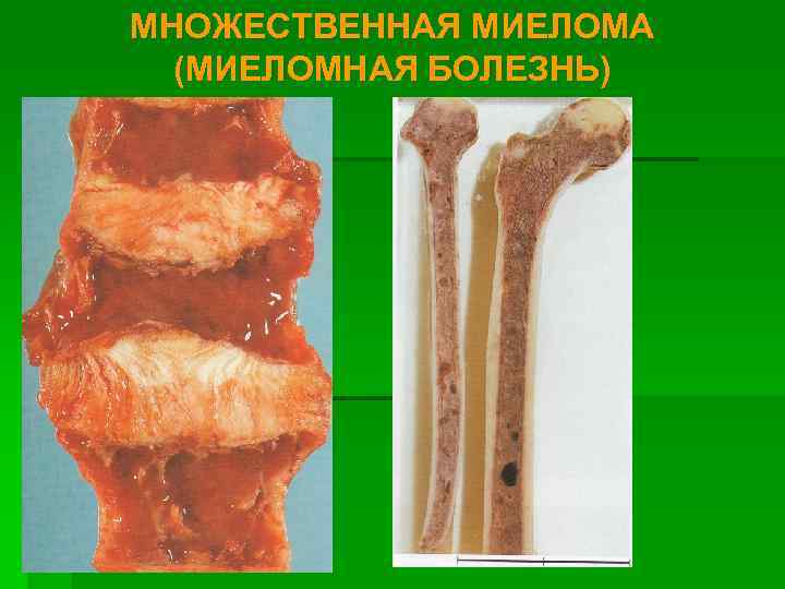 МНОЖЕСТВЕННАЯ МИЕЛОМА (МИЕЛОМНАЯ БОЛЕЗНЬ) 