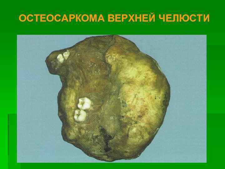 ОСТЕОСАРКОМА ВЕРХНЕЙ ЧЕЛЮСТИ 