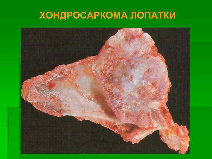 ХОНДРОСАРКОМА ЛОПАТКИ 