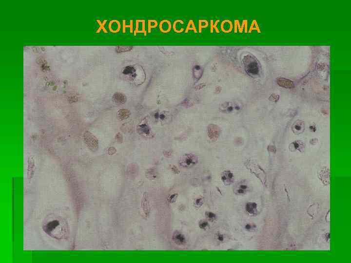 ХОНДРОСАРКОМА 