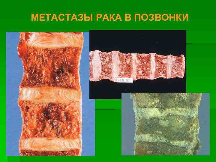 МЕТАСТАЗЫ РАКА В ПОЗВОНКИ 