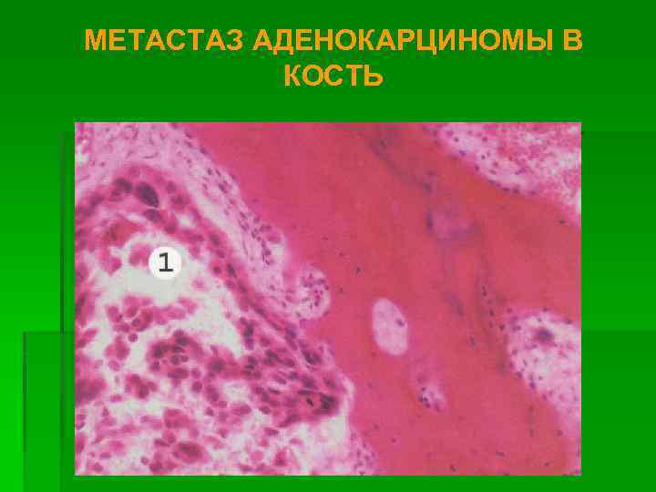 МЕТАСТАЗ АДЕНОКАРЦИНОМЫ В КОСТЬ 