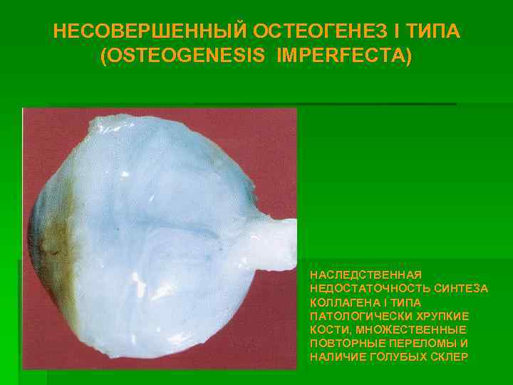 НЕСОВЕРШЕННЫЙ ОСТЕОГЕНЕЗ I ТИПА (OSTEOGENESIS IMPERFECTA) НАСЛЕДСТВЕННАЯ НЕДОСТАТОЧНОСТЬ СИНТЕЗА КОЛЛАГЕНА I ТИПА ПАТОЛОГИЧЕСКИ ХРУПКИЕ