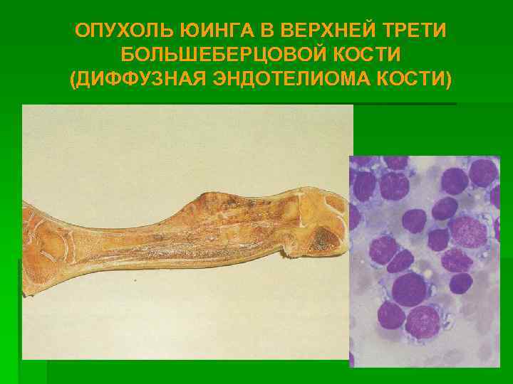 ОПУХОЛЬ ЮИНГА В ВЕРХНЕЙ ТРЕТИ БОЛЬШЕБЕРЦОВОЙ КОСТИ (ДИФФУЗНАЯ ЭНДОТЕЛИОМА КОСТИ) 
