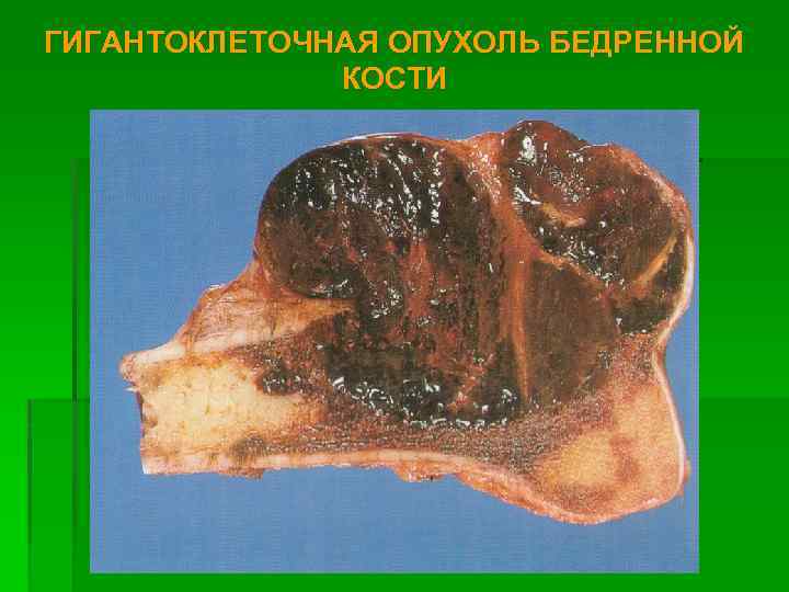 ГИГАНТОКЛЕТОЧНАЯ ОПУХОЛЬ БЕДРЕННОЙ КОСТИ 