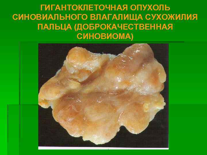 ГИГАНТОКЛЕТОЧНАЯ ОПУХОЛЬ СИНОВИАЛЬНОГО ВЛАГАЛИЩА СУХОЖИЛИЯ ПАЛЬЦА (ДОБРОКАЧЕСТВЕННАЯ СИНОВИОМА) 