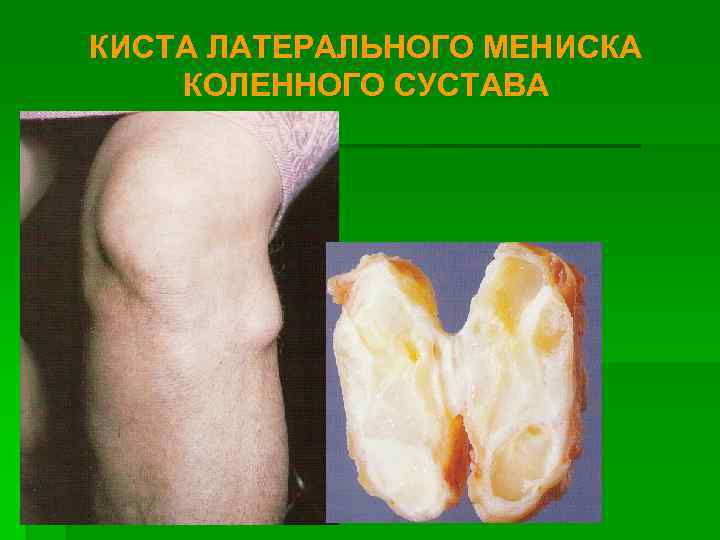 КИСТА ЛАТЕРАЛЬНОГО МЕНИСКА КОЛЕННОГО СУСТАВА 