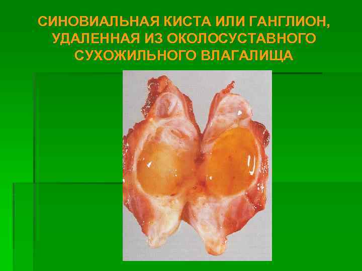 СИНОВИАЛЬНАЯ КИСТА ИЛИ ГАНГЛИОН, УДАЛЕННАЯ ИЗ ОКОЛОСУСТАВНОГО СУХОЖИЛЬНОГО ВЛАГАЛИЩА 