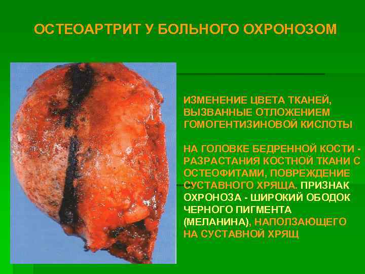ОСТЕОАРТРИТ У БОЛЬНОГО ОХРОНОЗОМ ИЗМЕНЕНИЕ ЦВЕТА ТКАНЕЙ, ВЫЗВАННЫЕ ОТЛОЖЕНИЕМ ГОМОГЕНТИЗИНОВОЙ КИСЛОТЫ НА ГОЛОВКЕ БЕДРЕННОЙ