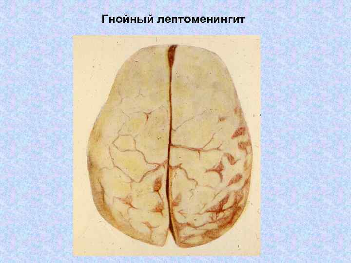 Гнойный лептоменингит 