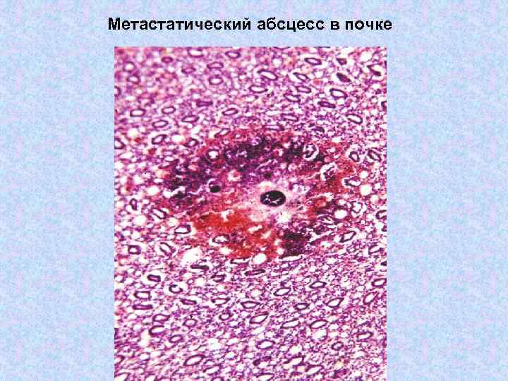 Метастатический абсцесс в почке 