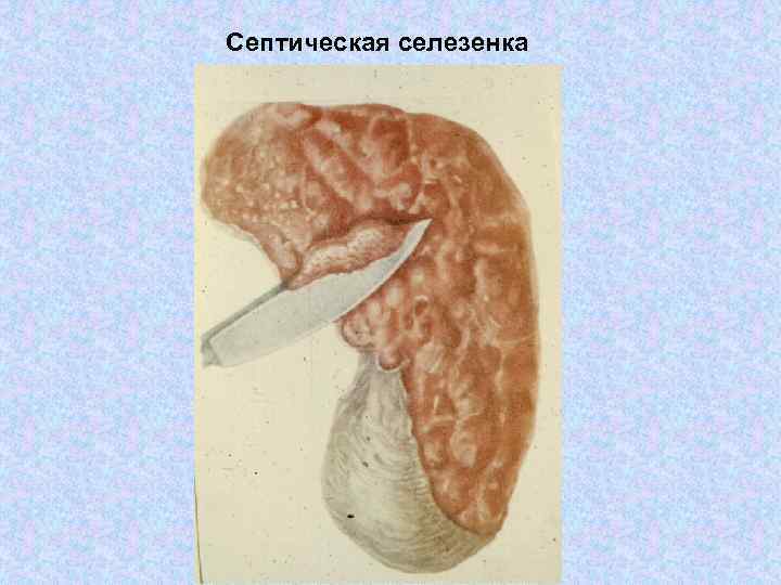 Септическая селезенка 