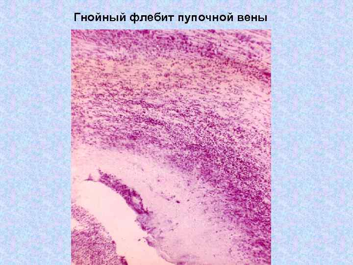 Гнойный флебит пупочной вены 