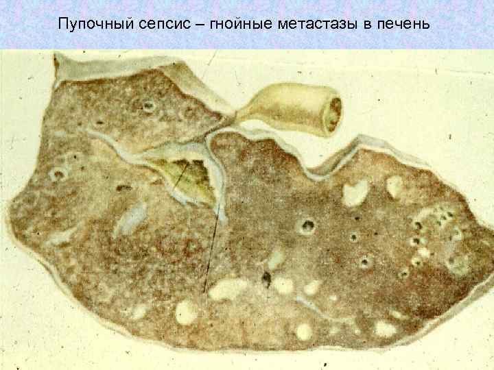 Пупочный сепсис – гнойные метастазы в печень 