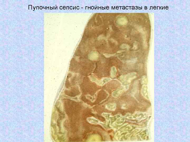 Сепсис легких. Сепсис с гнойными метастазами. Пупочный сепсис патологическая анатомия. Пупочный сепсис патанатомия.