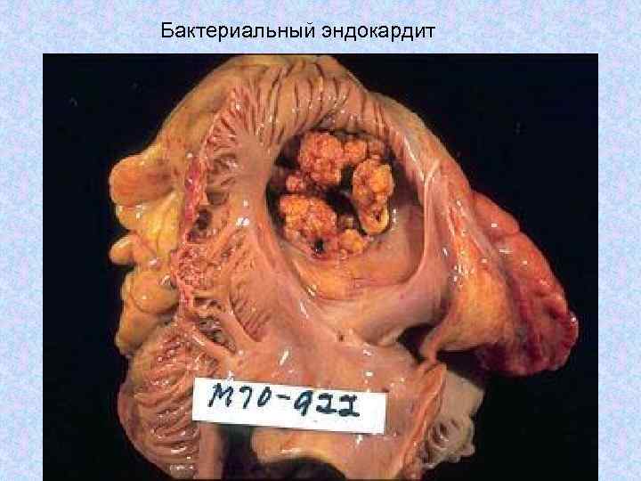 Бактериальный эндокардит 