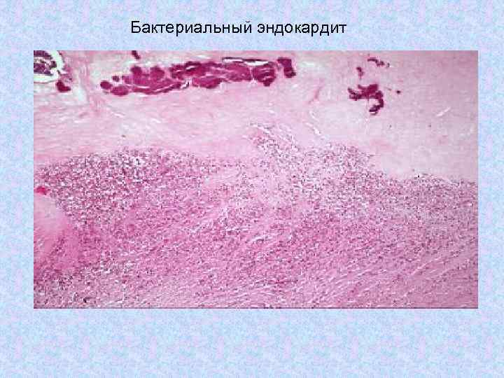 Бактериальный эндокардит 