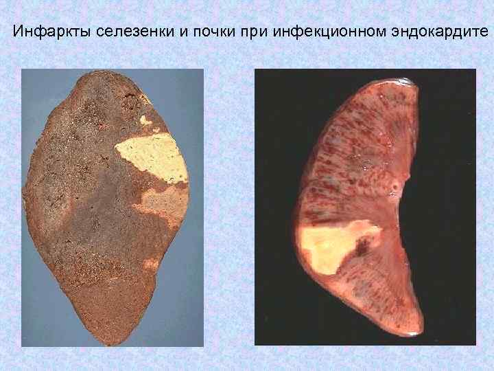 Инфаркты селезенки и почки при инфекционном эндокардите 
