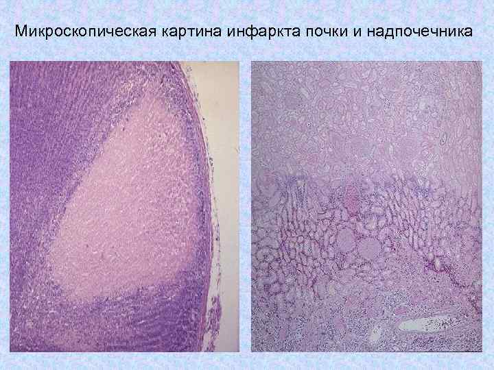Микроскопическая картина инфаркта почки и надпочечника 