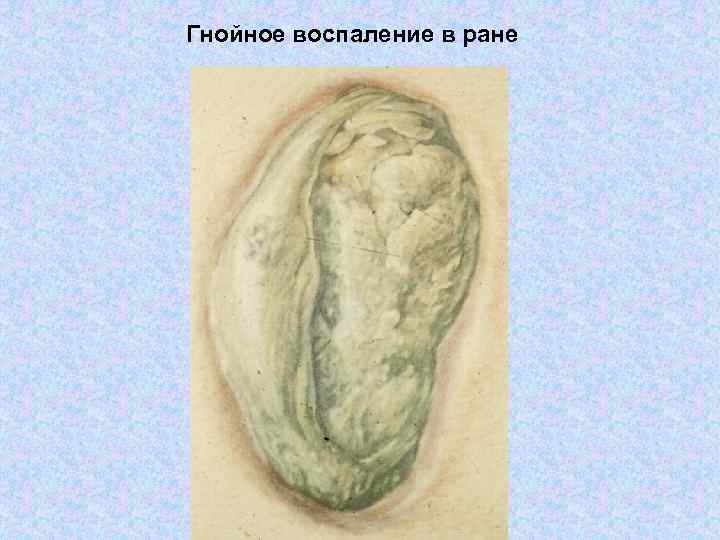 Гнойное воспаление в ране 