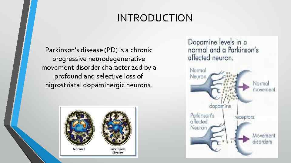 INTRODUCTION Parkinson's disease (PD) is a chronic progressive neurodegenerative movement disorder characterized by a