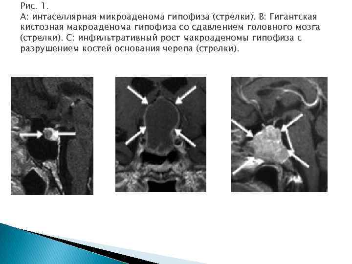 Рис. 1. A: интаселлярная микроаденома гипофиза (стрелки). B: Гигантская кистозная макроаденома гипофиза со сдавлением