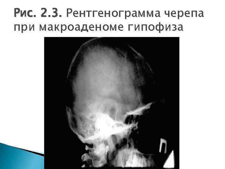 Рис. 2. 3. Рентгенограмма черепа при макроаденоме гипофиза 