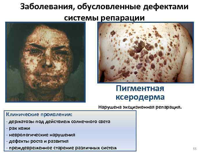 Заболевания, обусловленные дефектами системы репарации Пигментная ксеродерма Нарушена эксцизионная репарация. Клинические проявления: - дерматозы