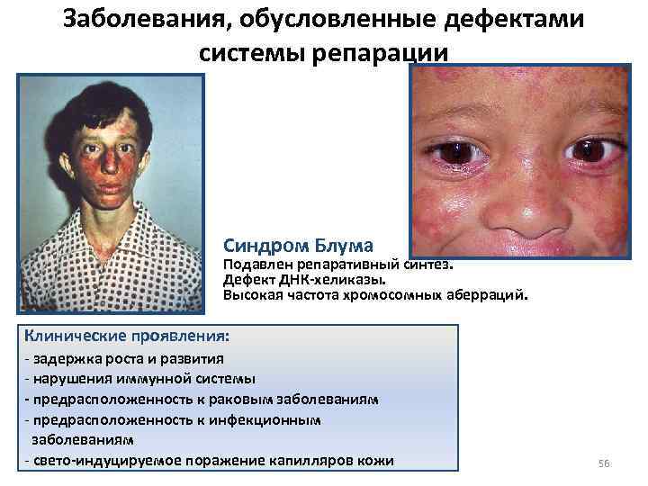Заболевания, обусловленные дефектами системы репарации Синдром Блума Подавлен репаративный синтез. Дефект ДНК-хеликазы. Высокая частота