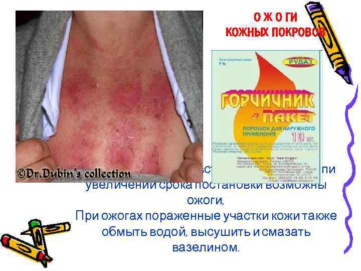 О Ж О ГИ КОЖНЫХ ПОКРОВОВ При чрезвычайно чувствительной коже или увеличении срока постановки