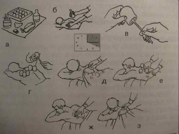 Как правильно ставить банки. Постановка банок и горчичников. Постановка банок и горчичников алгоритм. Техника постановки медицинских банок. Схема постановки медицинских банок.