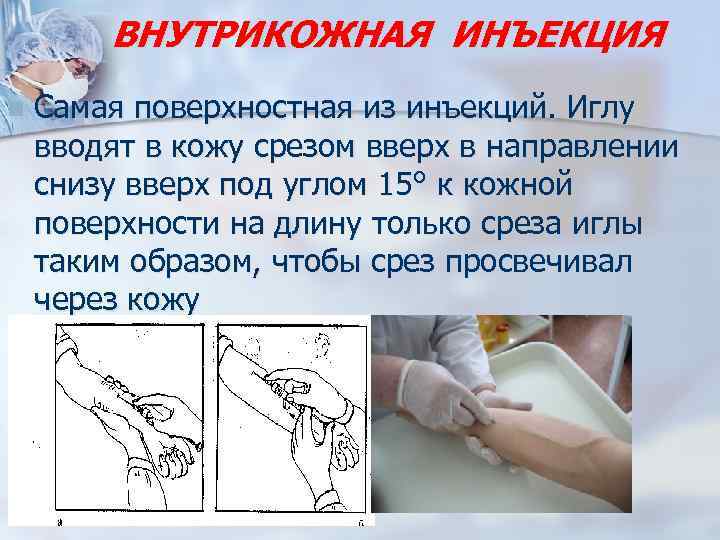 Внутрикожная инъекция