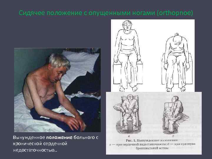 Сидячее положение с опущенными ногами (orthopnoe) Вынужденное положение больного с хронической сердечной недостаточностью. .