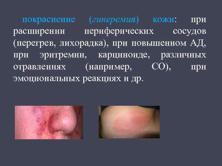 покраснение (гиперемия) кожи: при расширении периферических сосудов (перегрев, лихорадка), при повышенном АД, при эритремии,