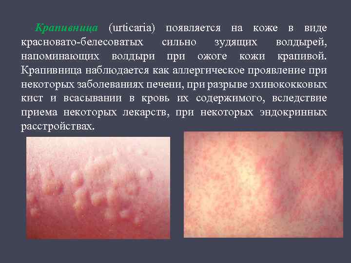 Крапивница (urticaria) появляется на коже в виде красновато белесоватых сильно зудящих волдырей, напоминающих волдыри