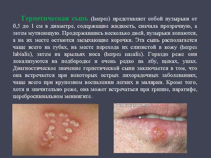 Герпетическая сыпь (herpes) представляет собой пузырьки от 0, 5 до 1 см в диаметре,