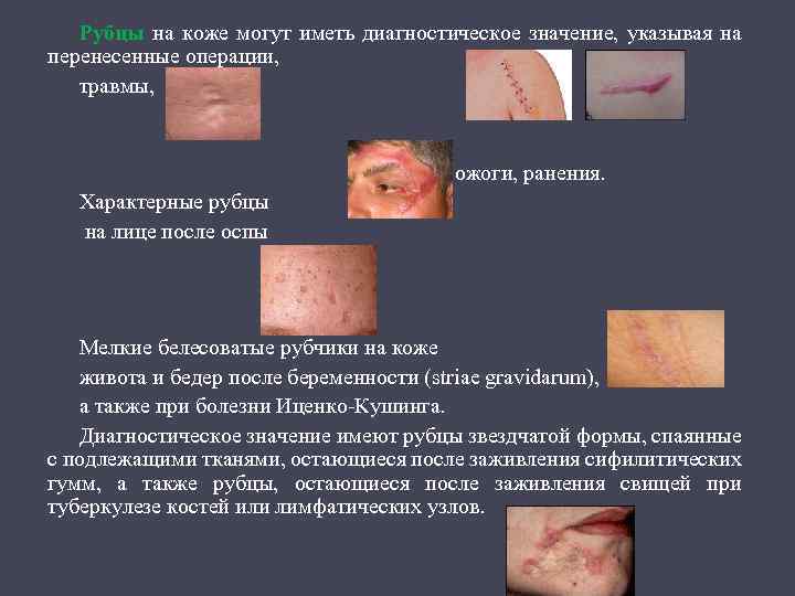 Рубцы на коже могут иметь диагностическое значение, указывая на перенесенные операции, травмы, ожоги, ранения.