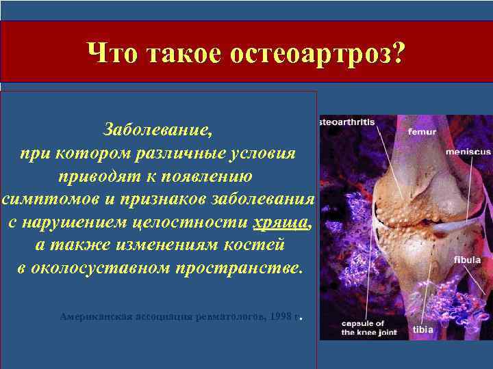 Что такое остеоартроз? Заболевание, при котором различные условия приводят к появлению симптомов и признаков