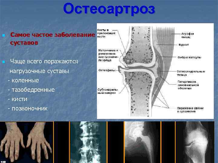 Остеоартроз n n Самое частое заболевание суставов Чаще всего поражаются нагрузочные суставы - коленные