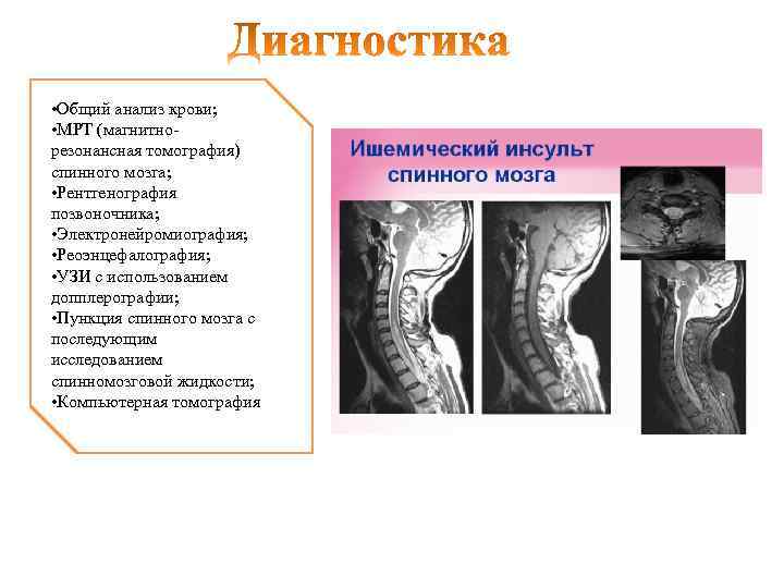 Спинальный инсульт лечение. Ишемический спинальный инсульт мрт. Спинальный инсульт на кт. Спинальный инсульт мрт. Инсульт спинного мозга мрт.