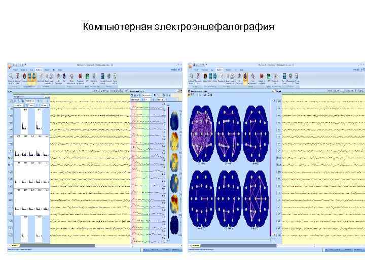 Компьютерная электроэнцефалография 